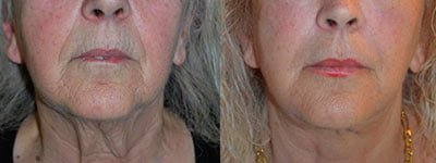 Before/After Patient Photo