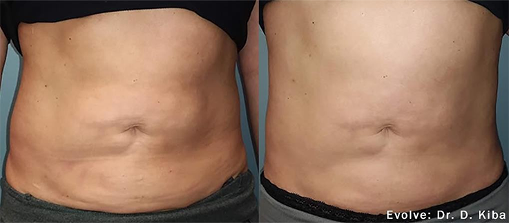  antes y después abdomen