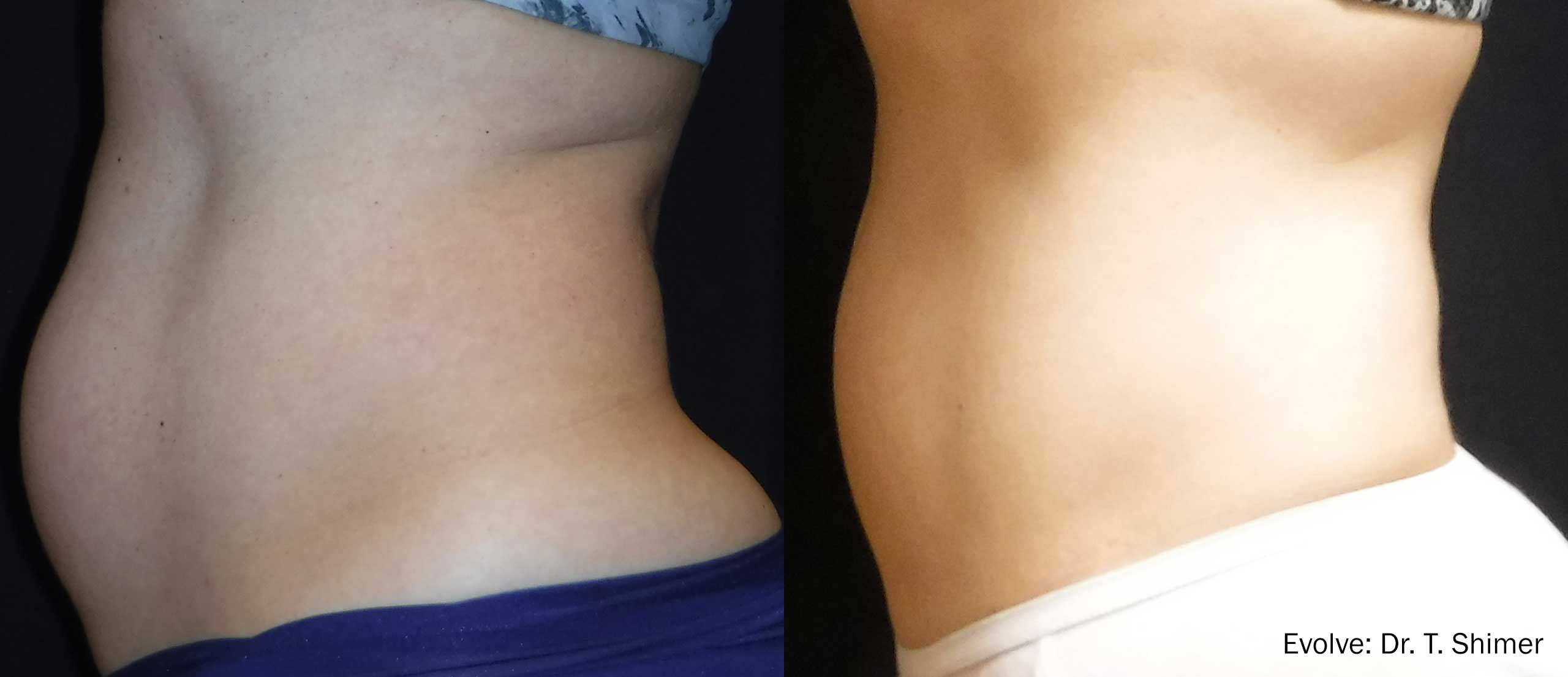  antes y después trim abdomen