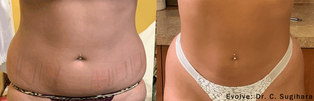Resultados antes y después de cómo eliminar la celulitis