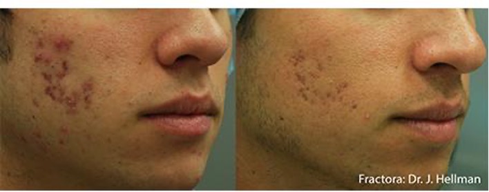 Fractora InMode para cicatrices de acné