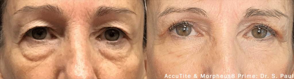 AccuTite y Morpheus8 Prime para párpados caídos