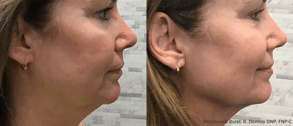 Rejuvenecimiento facial sin cirugía con Morpheus8 Burst