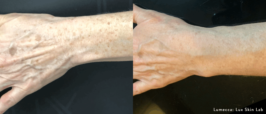 Lumecca Peak para eliminar manchas en manos