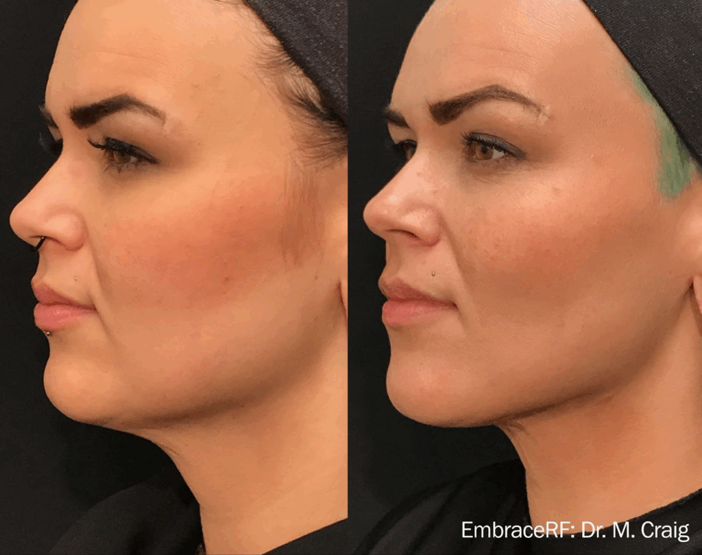 EmbraceRF InMode para redefinir mandíbula