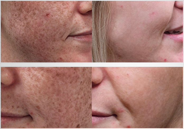 Antes y después, resultados Lumecca Peak