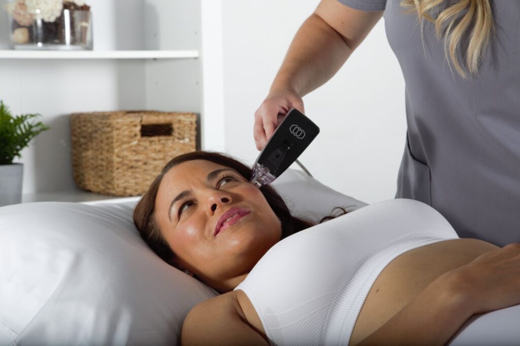 Elimina las ojeras con Morpheus8