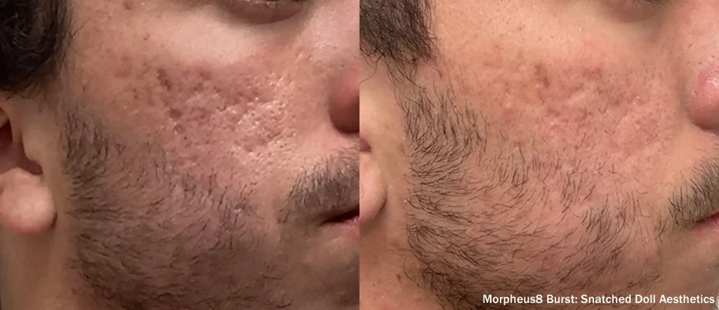 Luxora: Morpheus8 Burst para el rejuvenecimiento facial