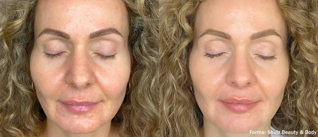 Luxora: Forma para el rejuvenecimiento facial