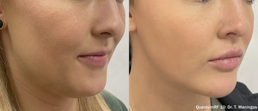 Luxora: QuantumRF 10 para el rejuvenecimiento facial