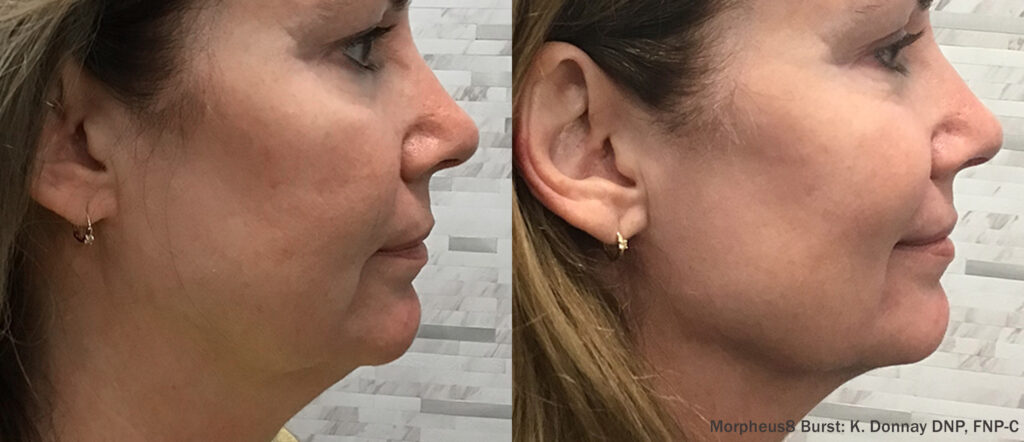 resultados lifting facial sin cirugía