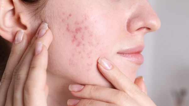Cuánto tarda en desaparecer una cicatriz de acné