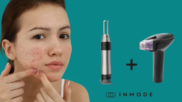 eliminar cicatrices de acné profundas