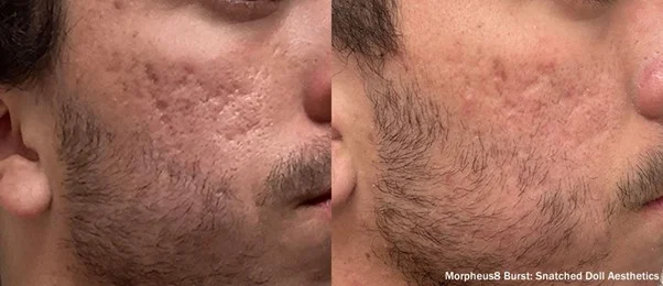 eliminar cicatrices profundas de acné con laser