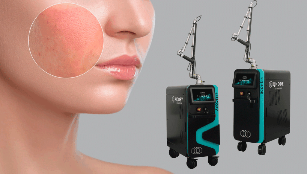 Picofy & QMode: manejo del melasma de moderado a severo
