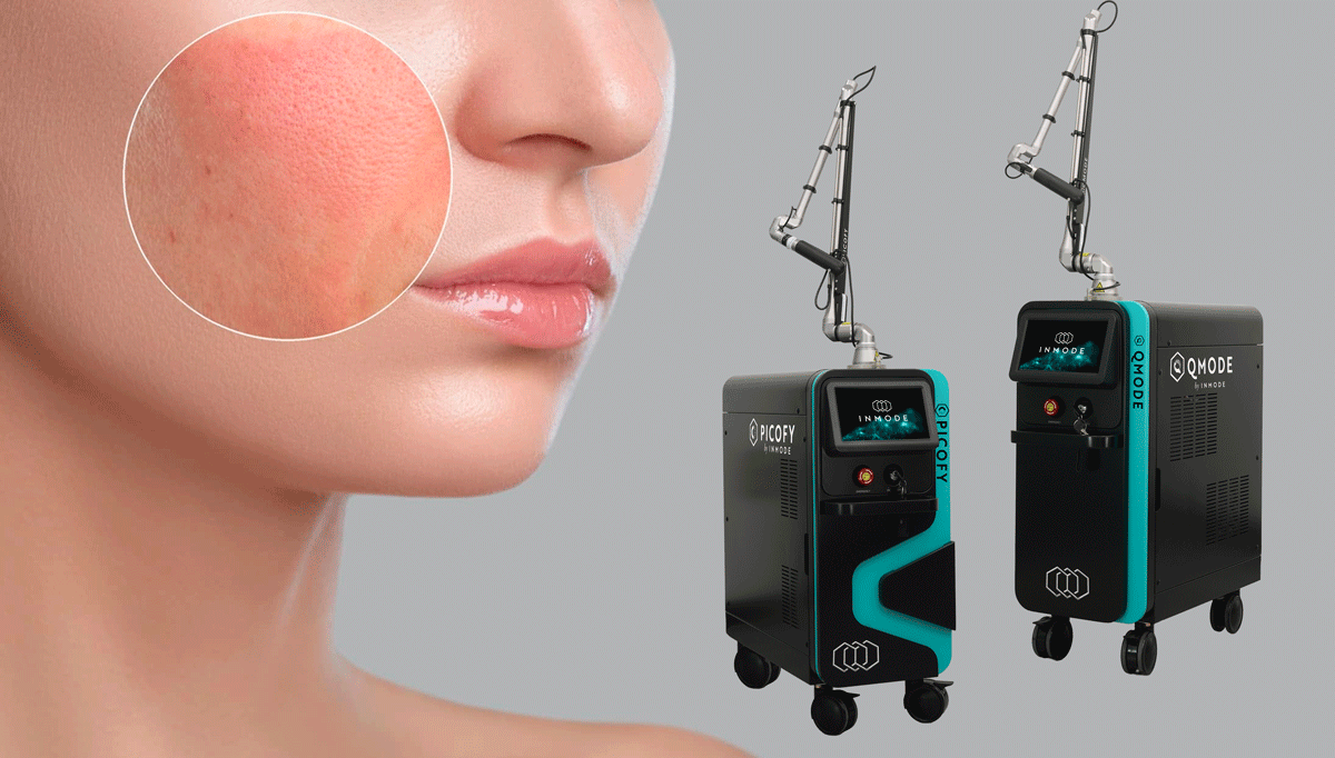 Picofy & QMode: manejo del melasma de moderado a severo