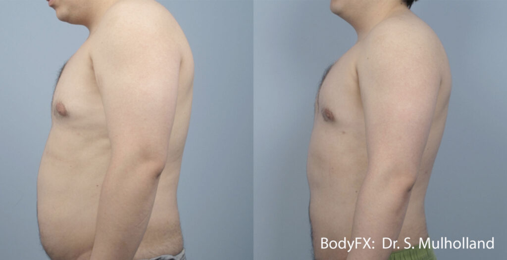 redefinición corporal con BodyFX Pro y MiniFX Pro