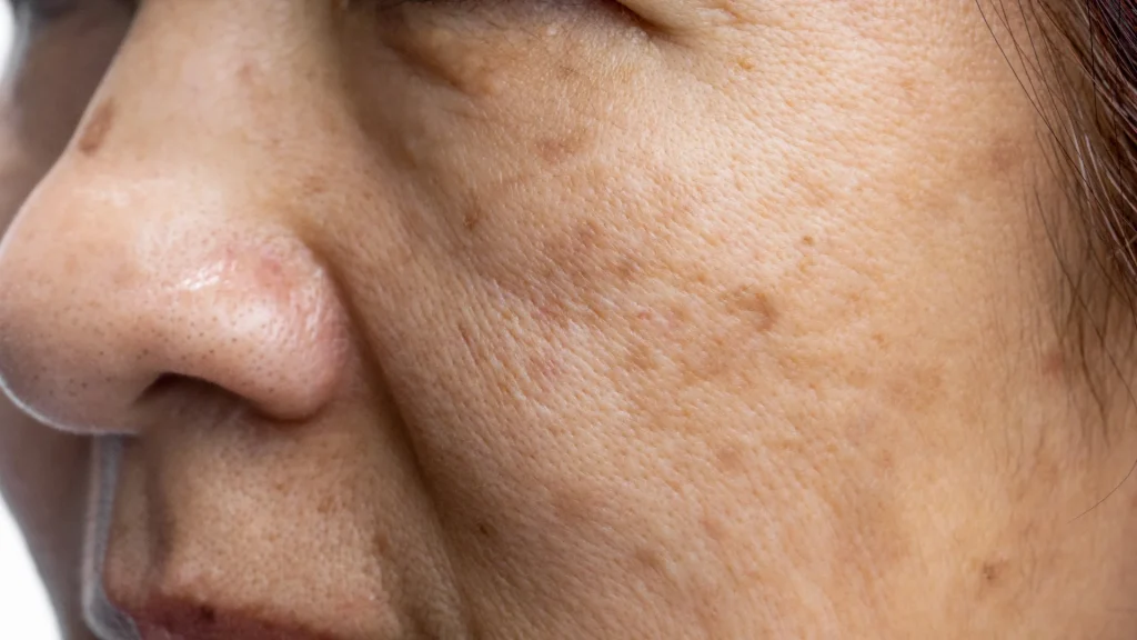 melasma qué es