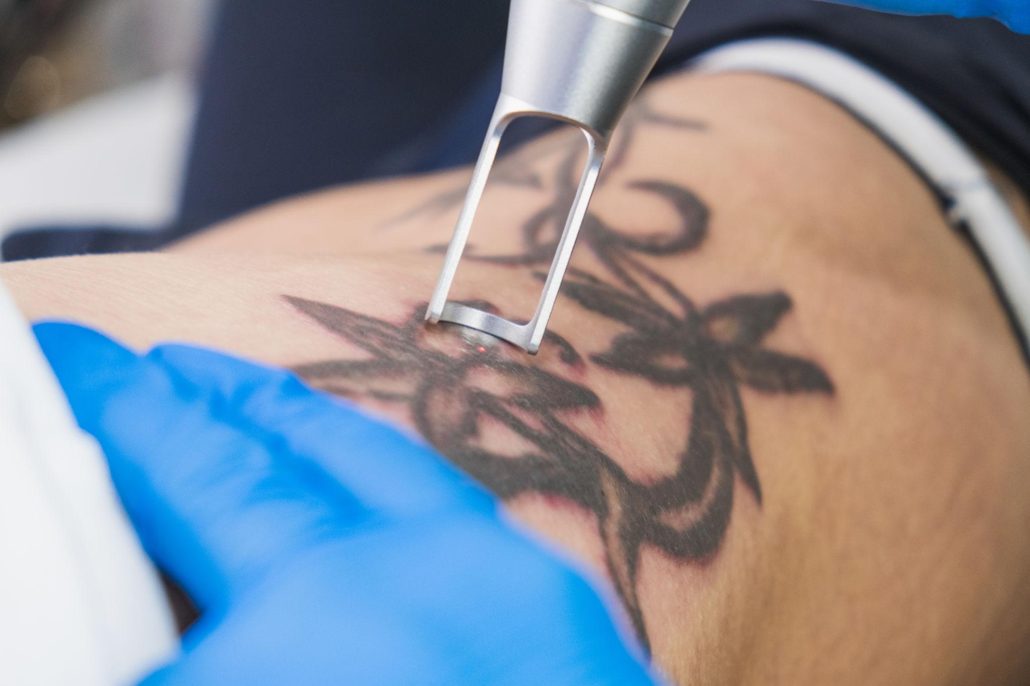 eliminación de tatuajes