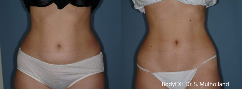 Antes y después BodyFX Pro