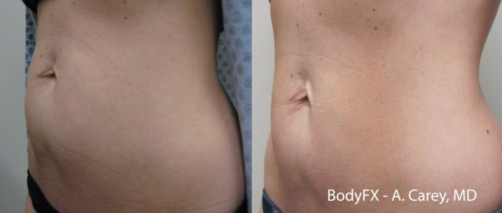 Antes y después BodyFX Pro