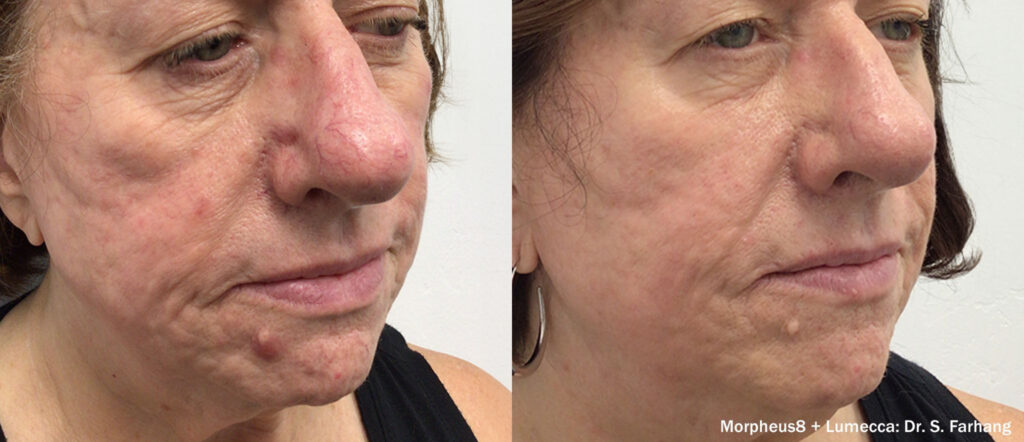 Blefaroplastia sin cirugía resultados