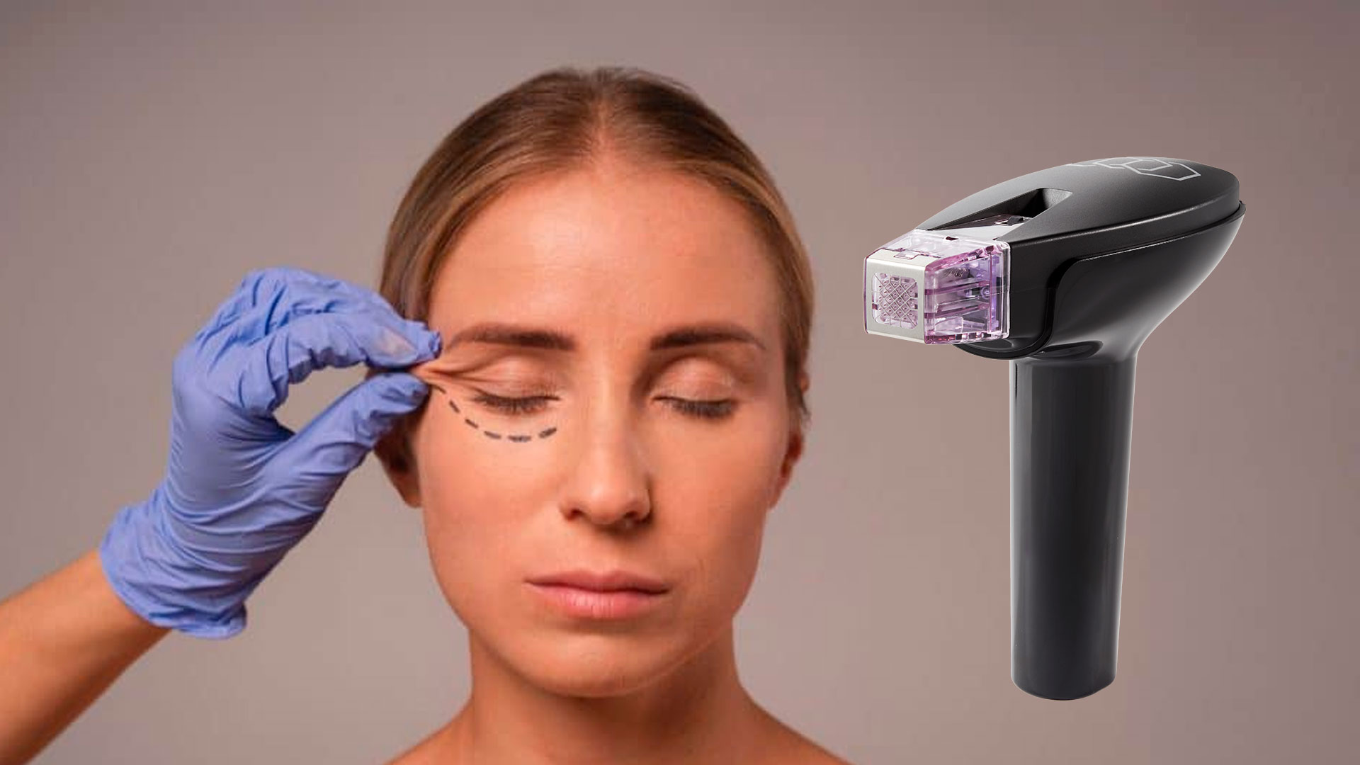 Morpheus8 para tensado periocular: protocolo médico para tratar párpado inferior y arrugas bajo los ojos